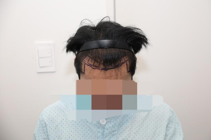 뉴헤어 모발이식 1800모낭 1개월차 후기