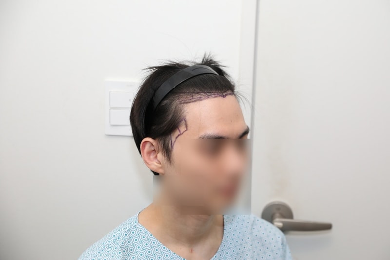 뉴헤어 모발이식 1200모낭 9개월차 후기