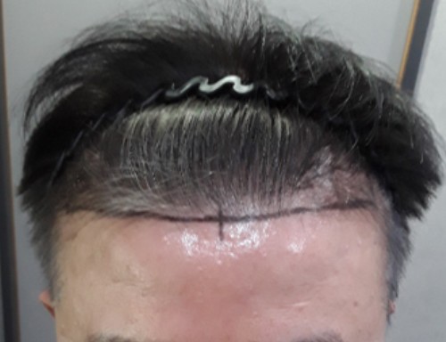 수술전에 앞모습이이랬네.jpg