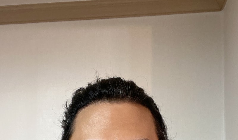 다나 M자 모발이식 1년 9개월