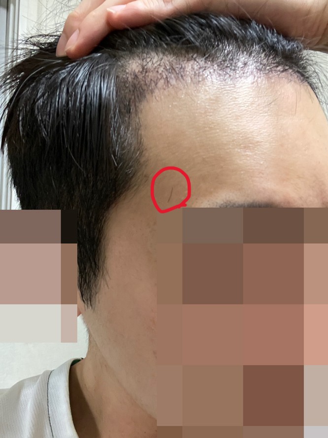 무삭발모발이식 다나 12개월 후기입니다!