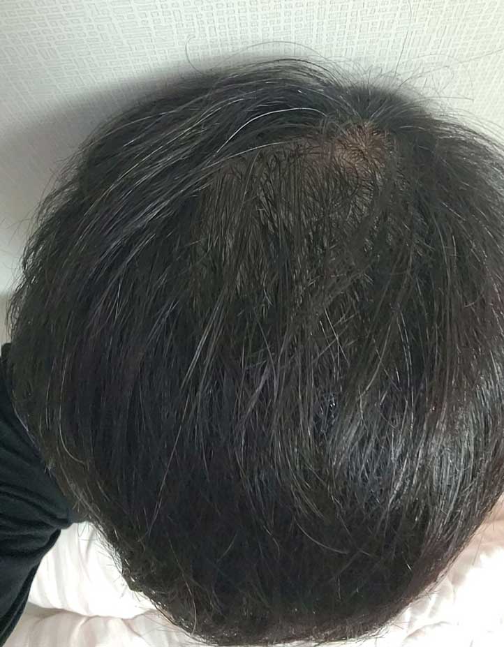 다나 정수리포함 대량모발이식 9개월차