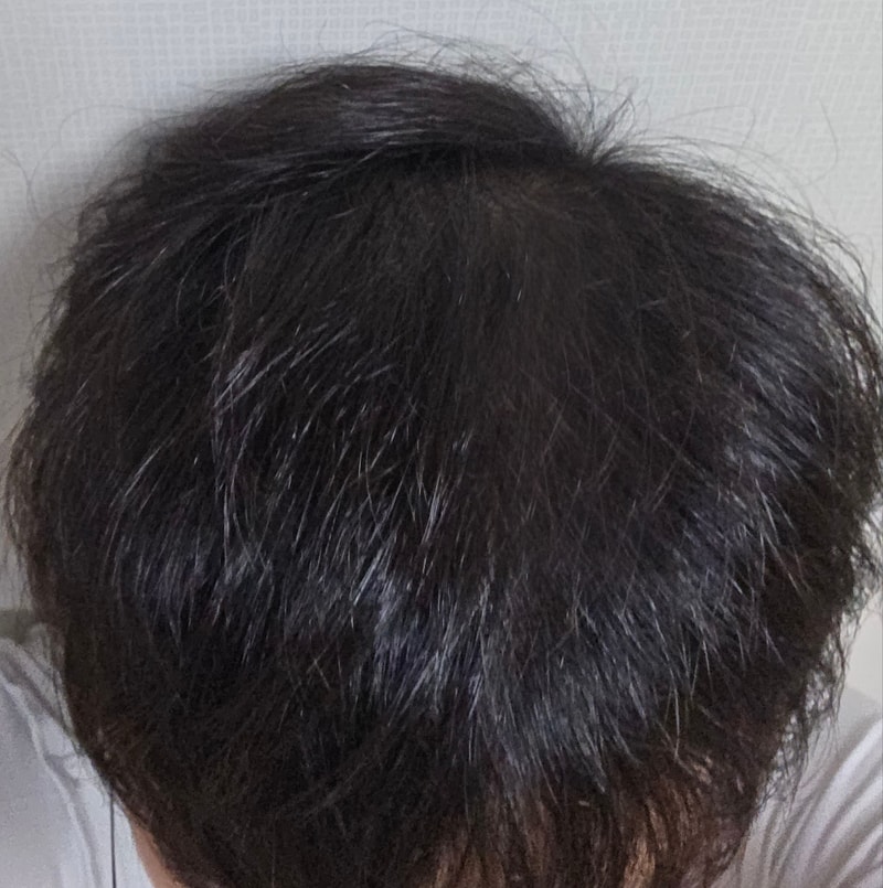 대량모발이식 다나성형외과 정수리 5000모 13개월후기