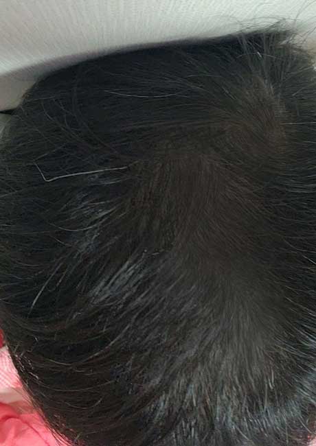 다나 정수리포함 대량모발이식 10개월차입니다