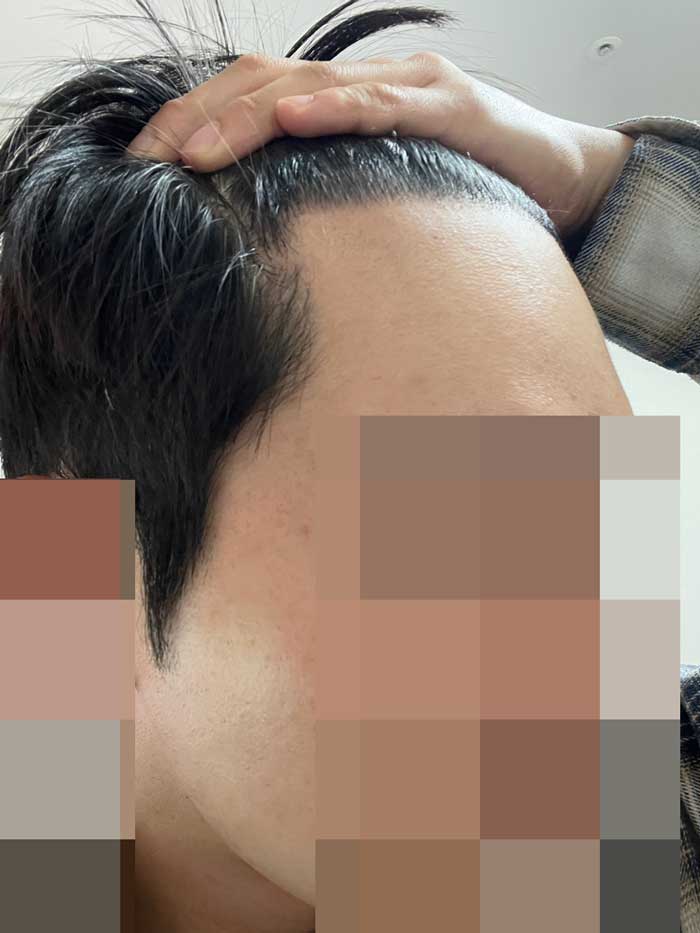 다나성형외과 무삭발모발이식 10개월!