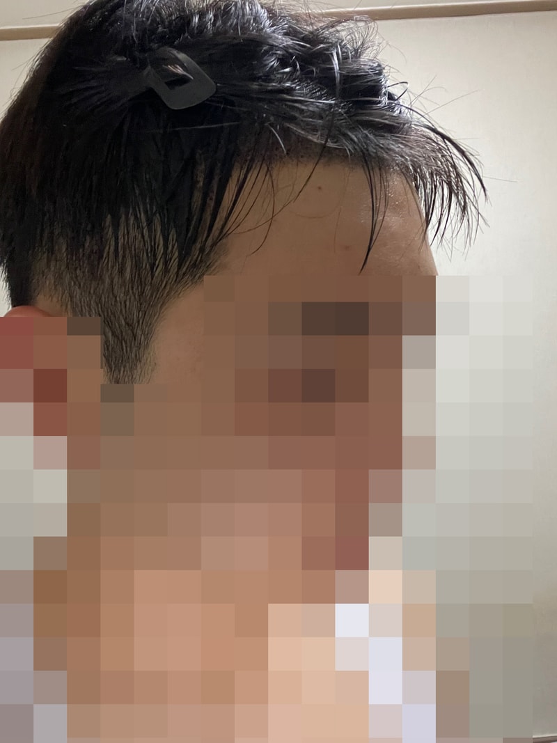다나성형외과 무삭발비절개 14개월 경과ㅎㅎ