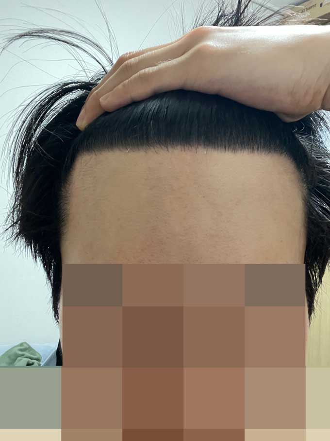 다나성형외과 무삭발모발이식 11개월 후기입니다!