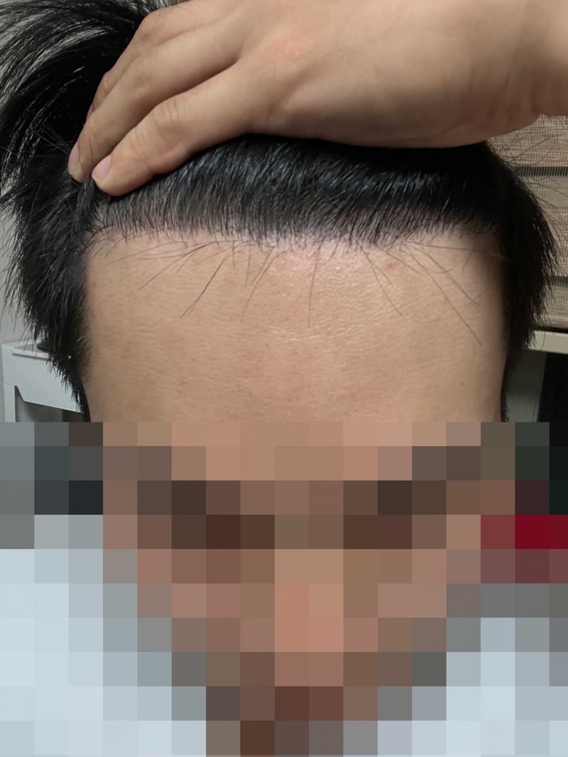 무삭발비절개 16개월-다나성형외과