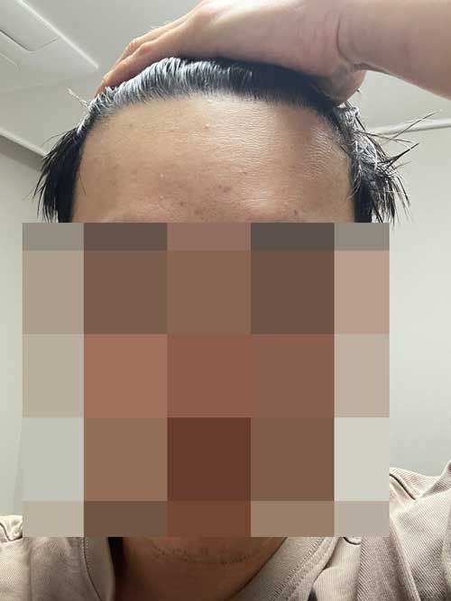 다나성형외과 무삭발모발이식 9개월!