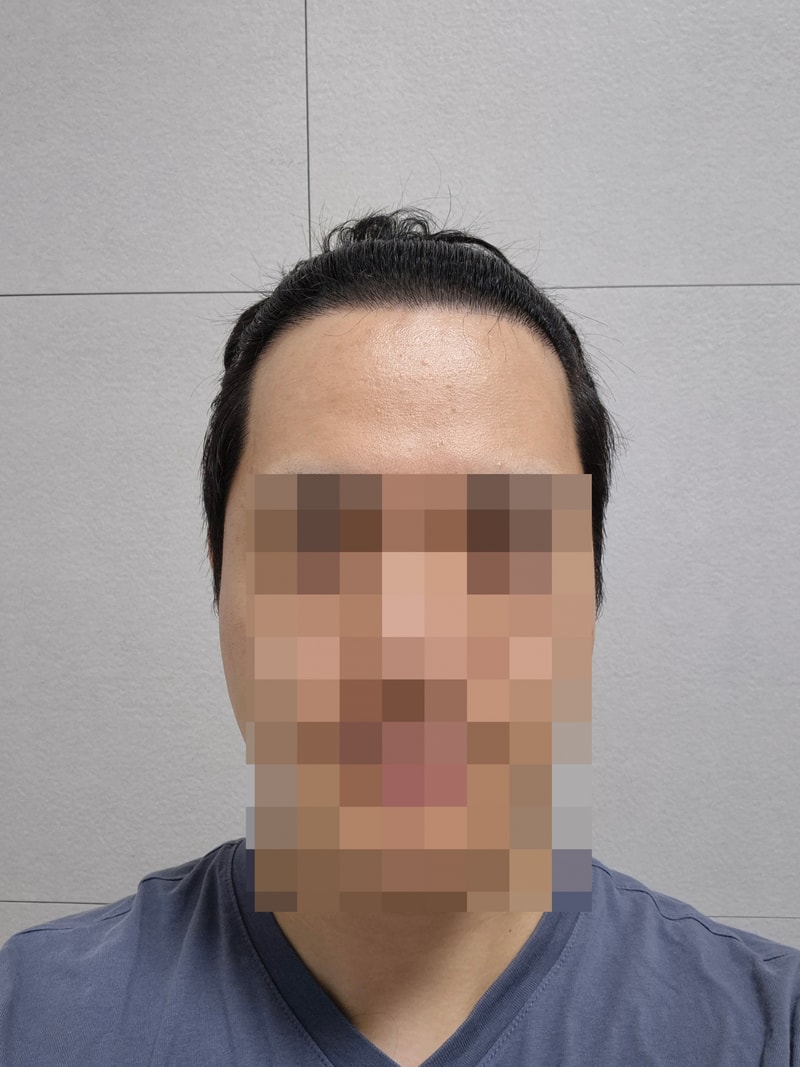 앞머리탈모 모발이식 365일 경과 [다나성형외과]