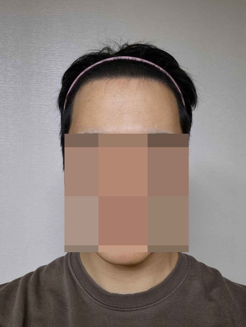 다나성형외과/비절개/5개월입니다 ㅎㅎ