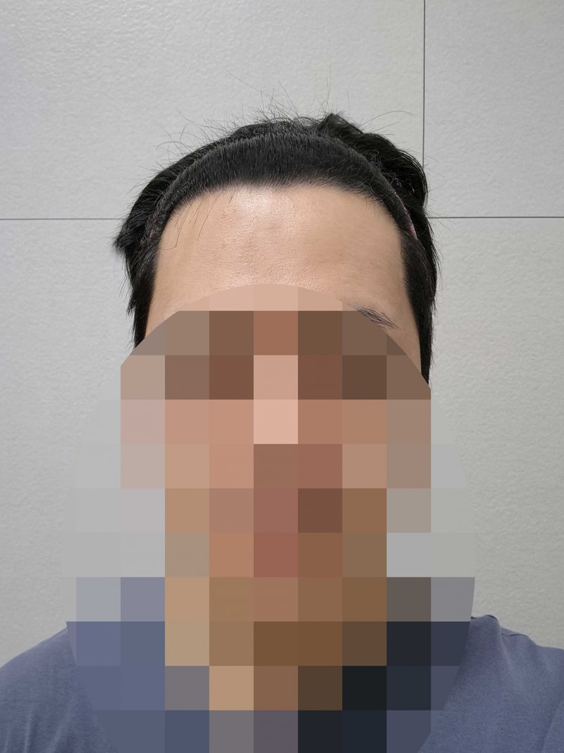 이마축소vs모발이식 중에 후자를 택한 이유 (다나, 비절개모발이식, 2400모 14개월차)