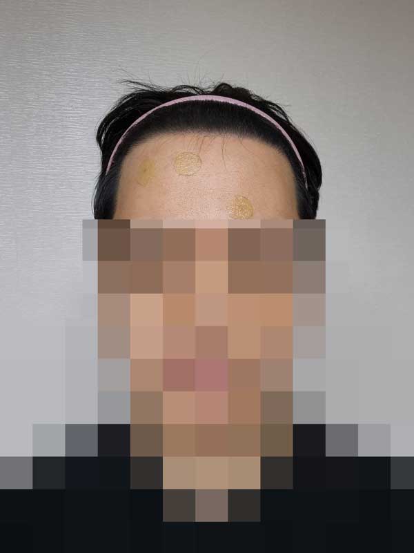 다나성형외과/비절개/6개월입니다 ㅎㅎ