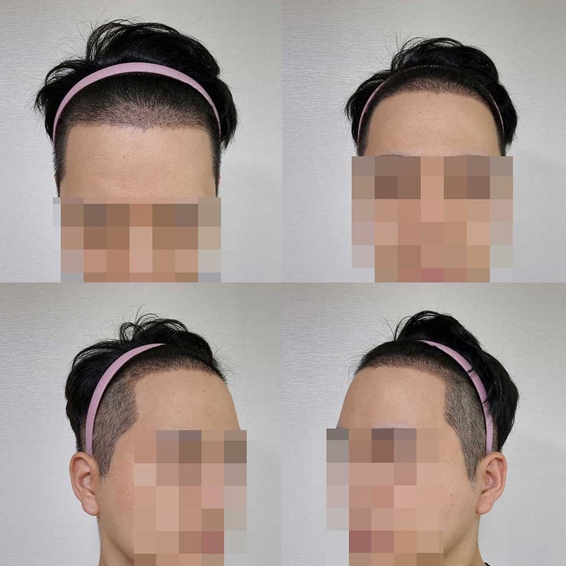비절개모발이식 395일 경과 [다나성형외과]