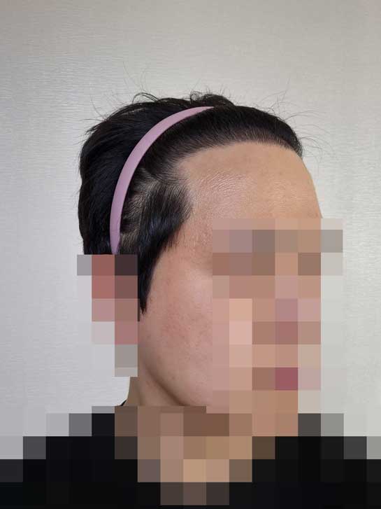 다나성형외과/비절개/7개월입니다 ㅎㅎ