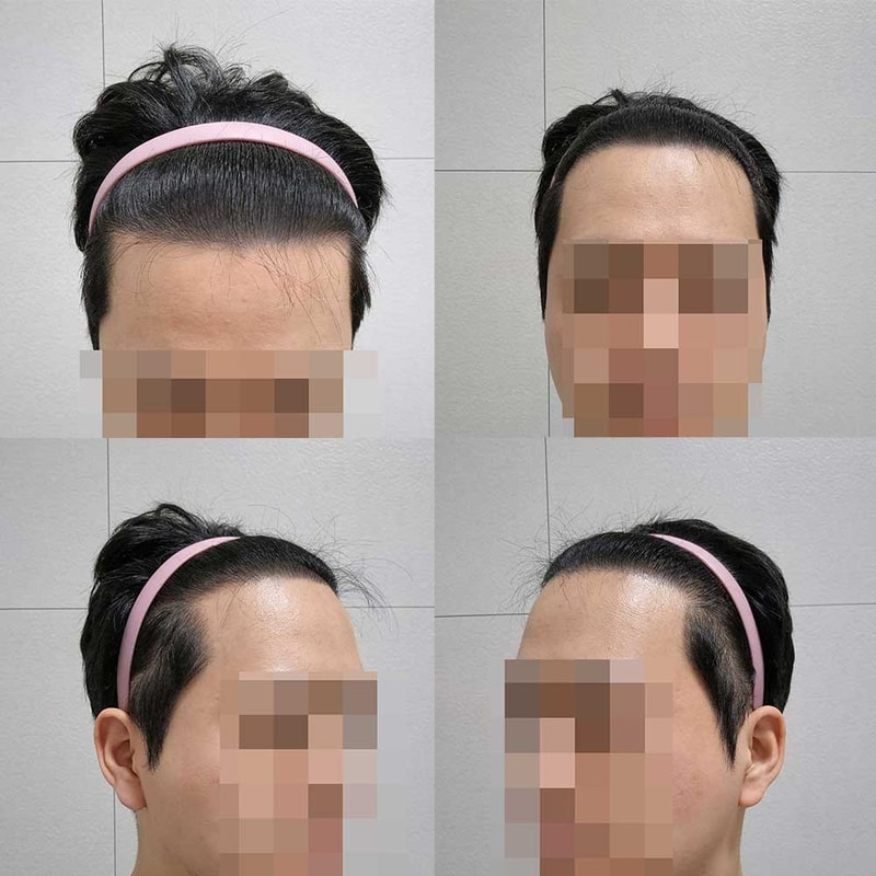 비절개모발이식13개월차입니다.jpg