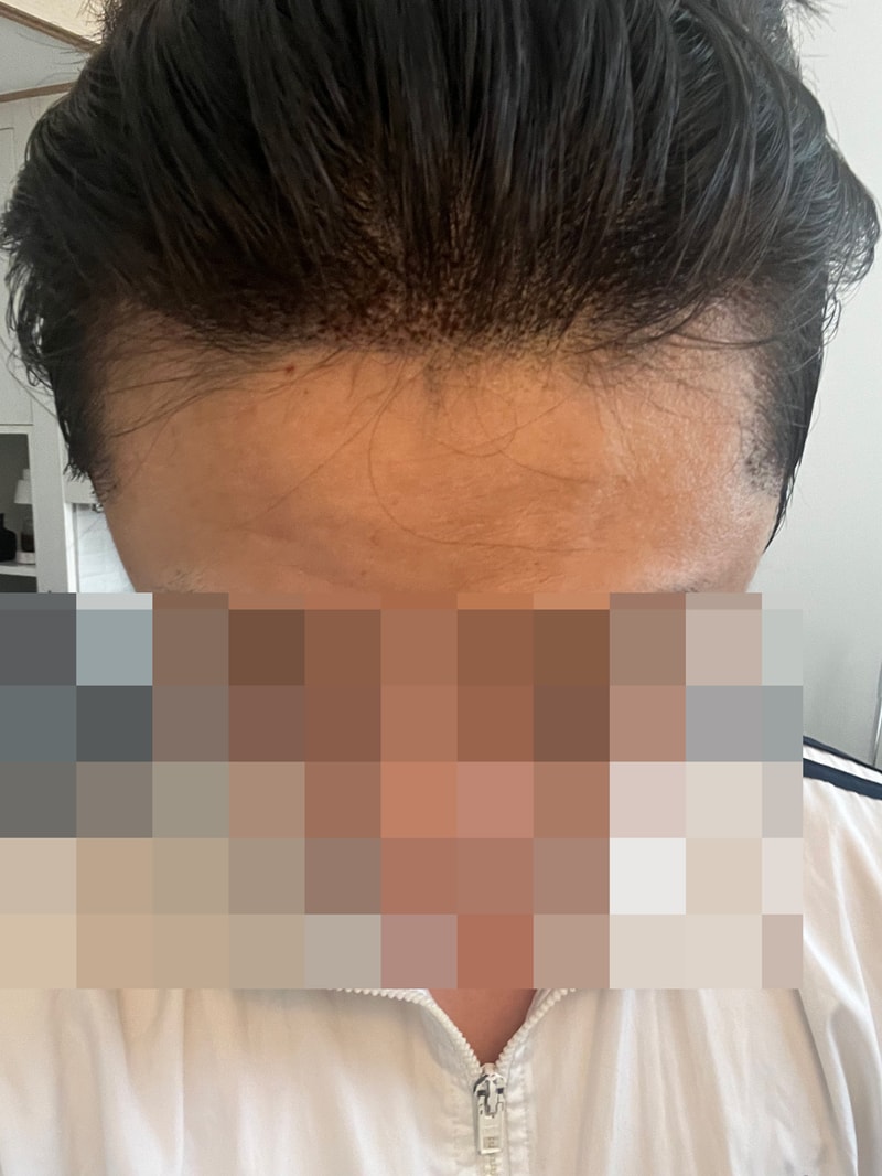 무삭발비절개/다나성형외과/13개월차!/무삭발 저렴하게 받는 법 추가