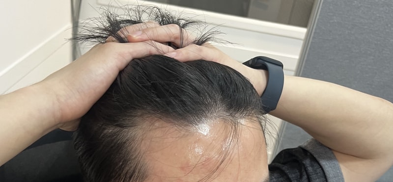 다나 엠자탈모 무삭발모발이식 5달이요!