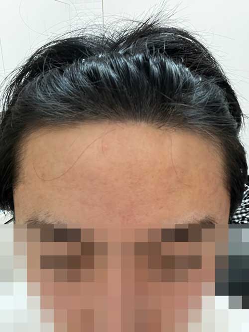 무삭발모발이식/다나/8개월차!