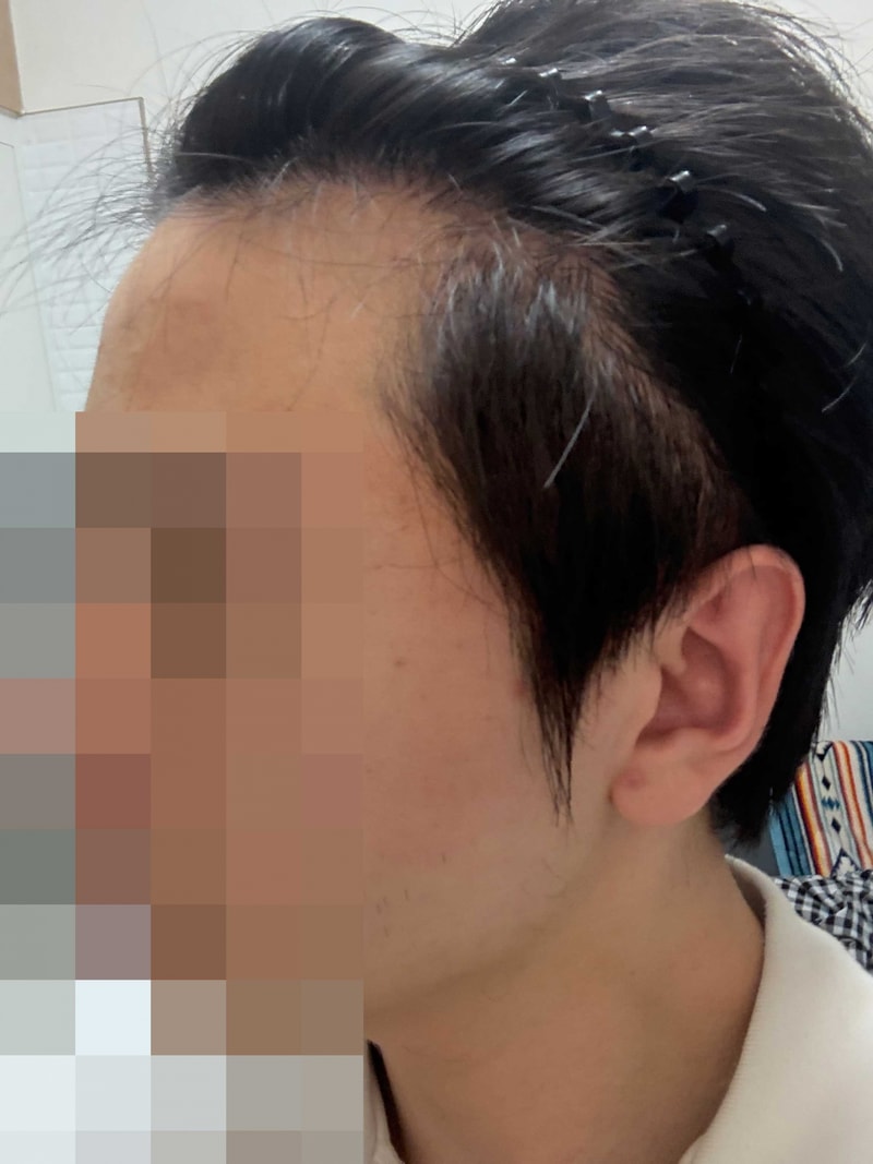 조기수술 선택한 이유 - 다나 무삭발 15개월차