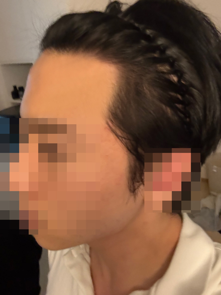 무삭발비절개/다나성형외과/1년차!!ㅎㅎㅎㅎ