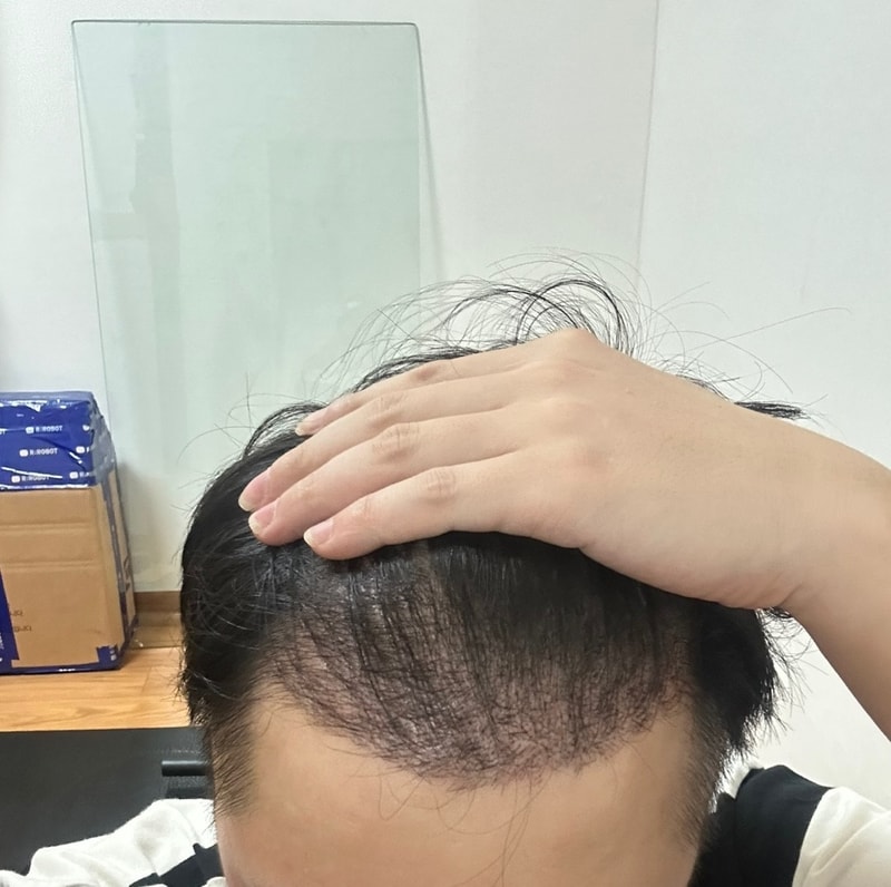 다나성형외과 모발이식재수술 16일차