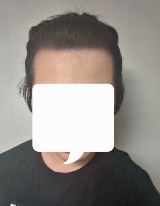엠자탈모 찐으로 깊었던 30대입니다ㅋㅋ 다나 비절개 13개월