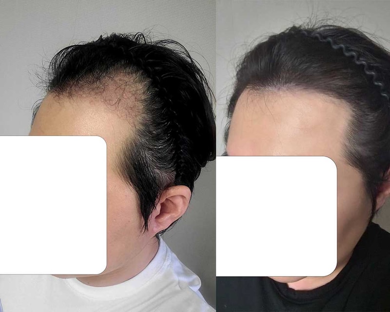 다나성형외과 5600모 비절개+무삭발 모발이식 16개월