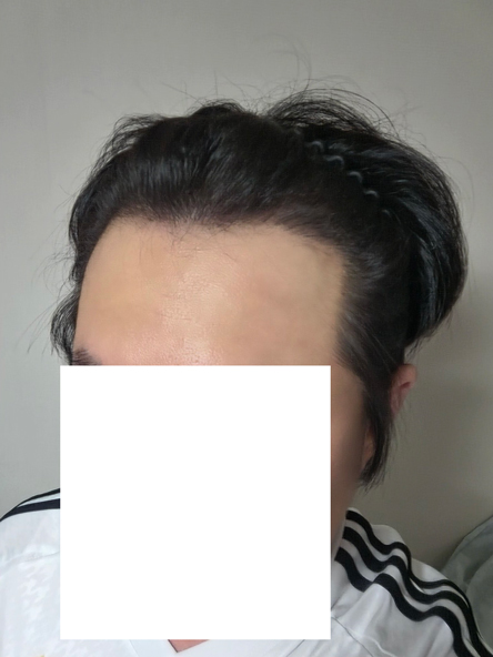 다나성형외과 비절개이식 14개월입니다 +무삭발