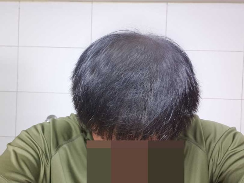 대머리남에서 탈출? 탈출!! 대량모발이식 다나성형외과 9개월,,ㅋㅋ
