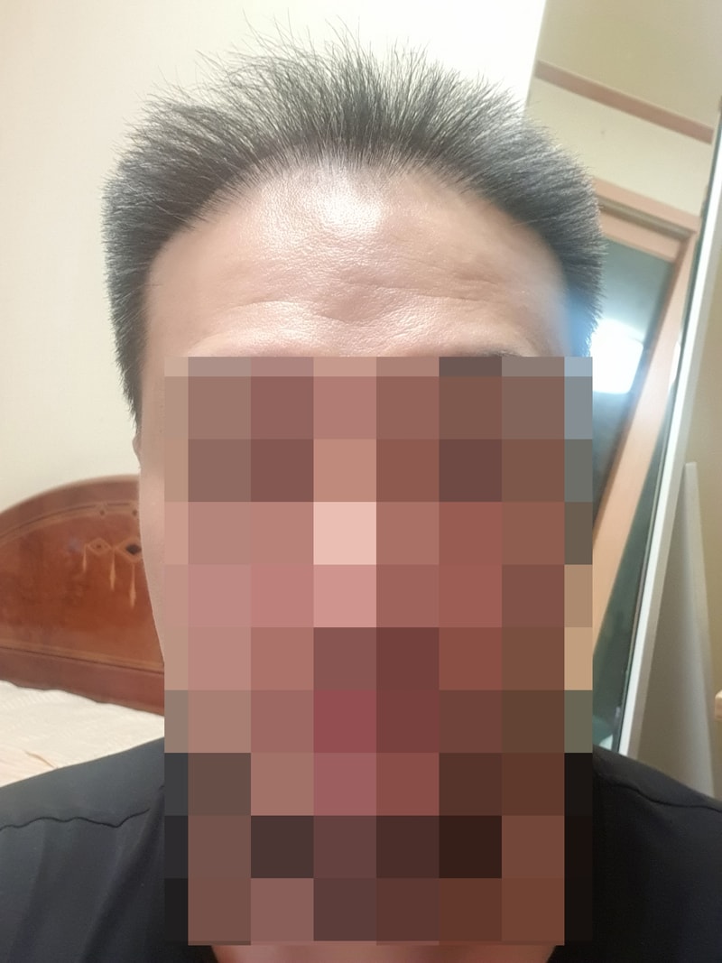 40대남 다나성형외과 4400모 1년1개월차임