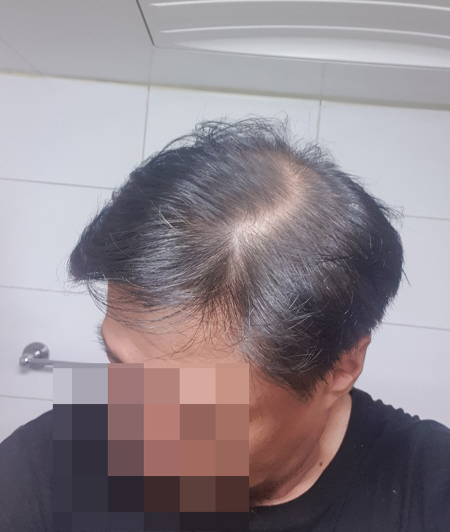 대량모발이식 40대남 다나성형외과 4400모 1년후기