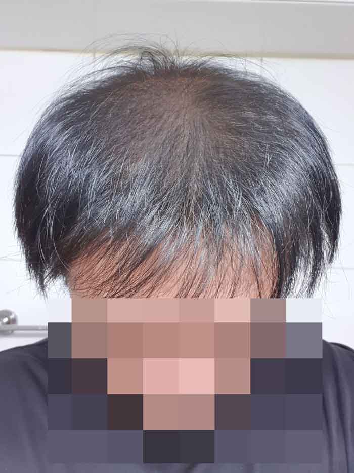 다나성형외과 대량이식 4400모 7개월