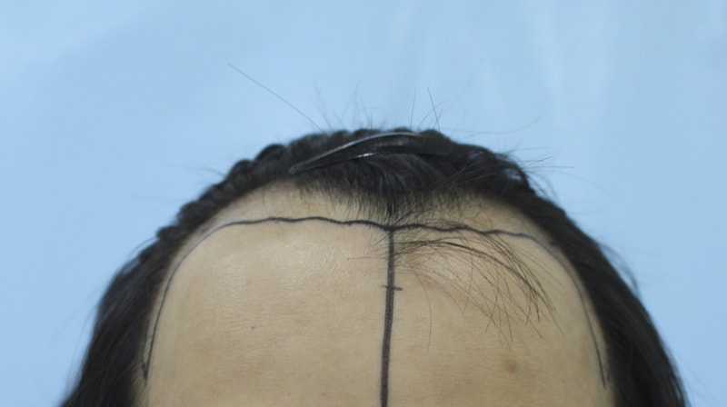 이식전 (1).jpg