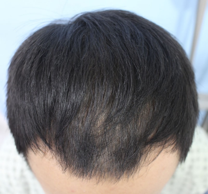 헤어 라인이랑 앞쪽으로 이식했는데 봐주세요~