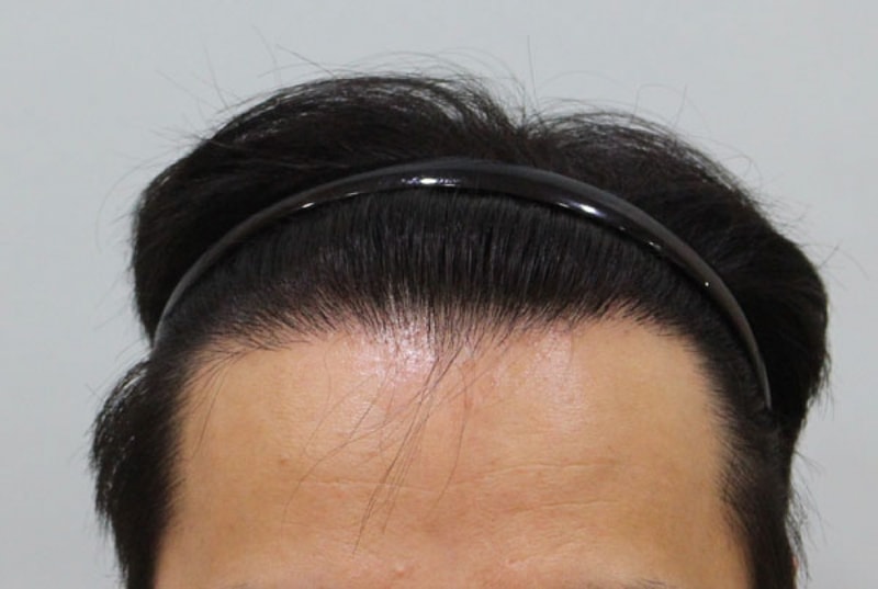 수술후 정면.jpg