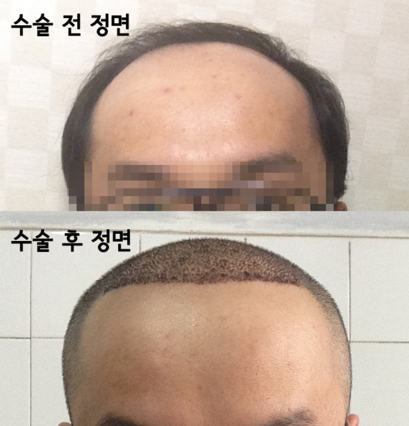 모발이식 수술 전 후 -정면.jpg