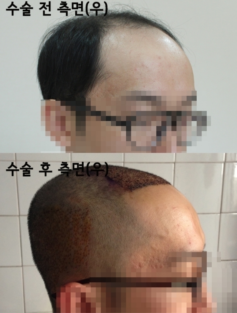 모발이식 수술 전 후 측면(우).jpg
