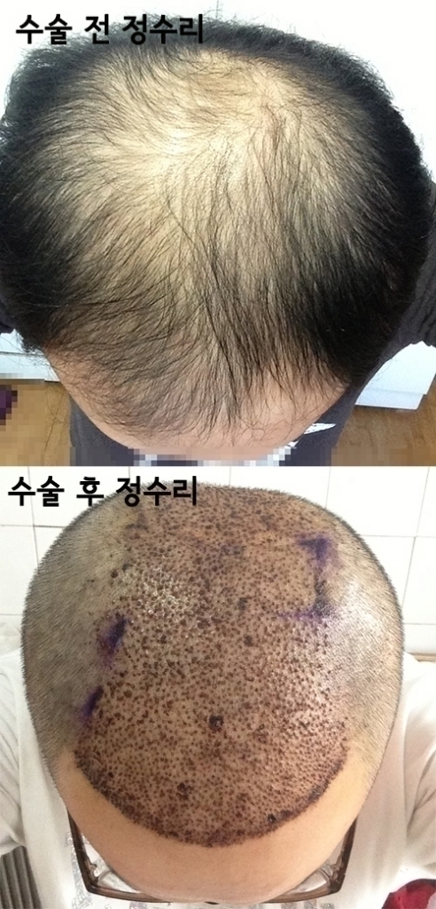 모발이식 수술 전 후 -정수리.jpg