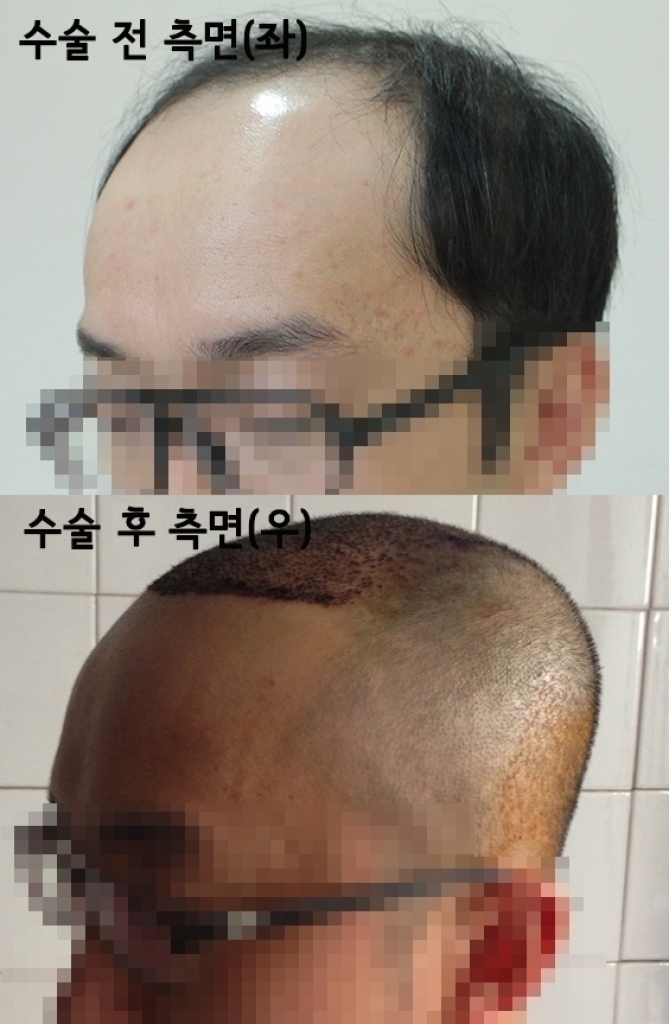 모발이식 수술 전 후 측면(좌).jpg
