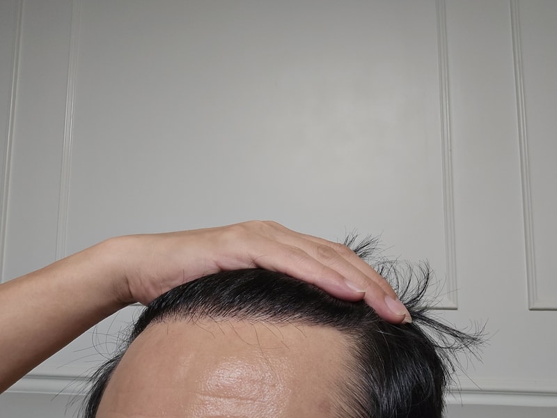 다나 무삭발모발이식 11개월됐습니다