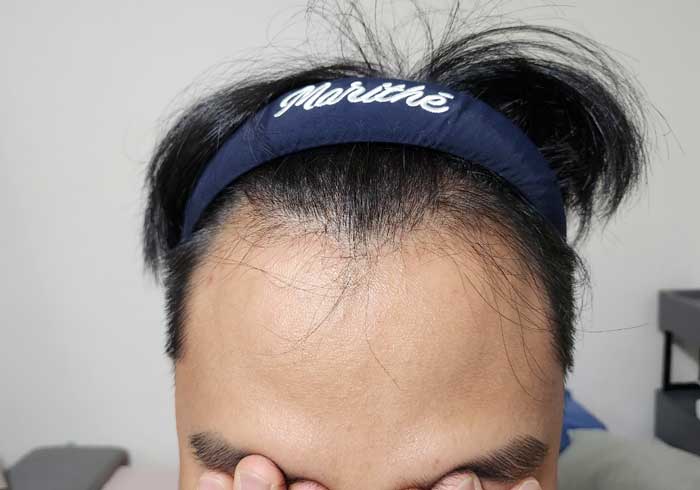 이식전 날것 그자체다.jpg