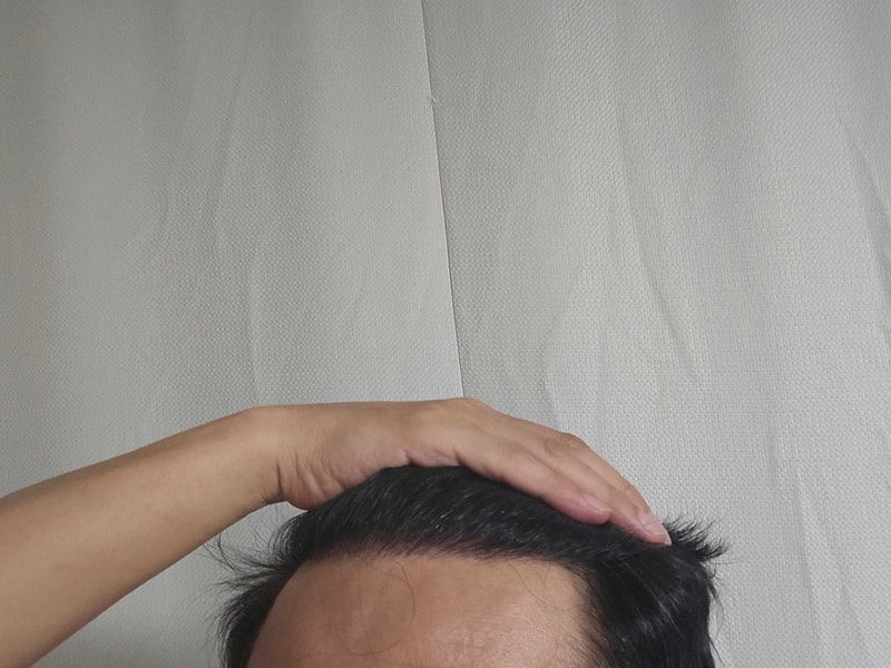 무삭발 고려하시는 분들께. 다나, 비절개무삭발, 22개월차 후기입니다.