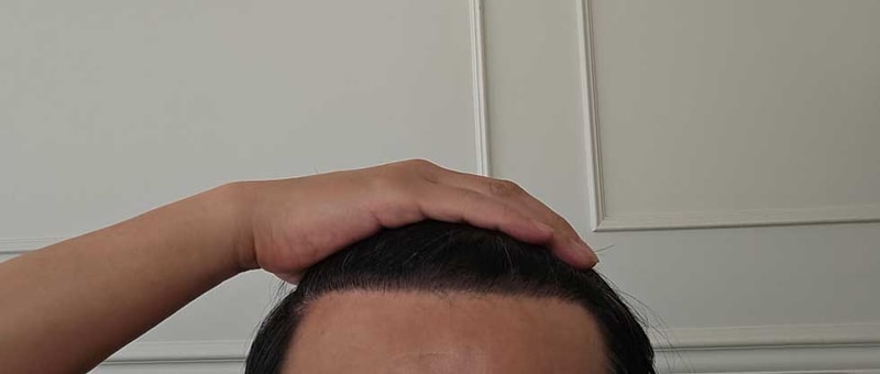 다나성형외과에서 무삭발모발이식 1년 4개월 됐습니다.
