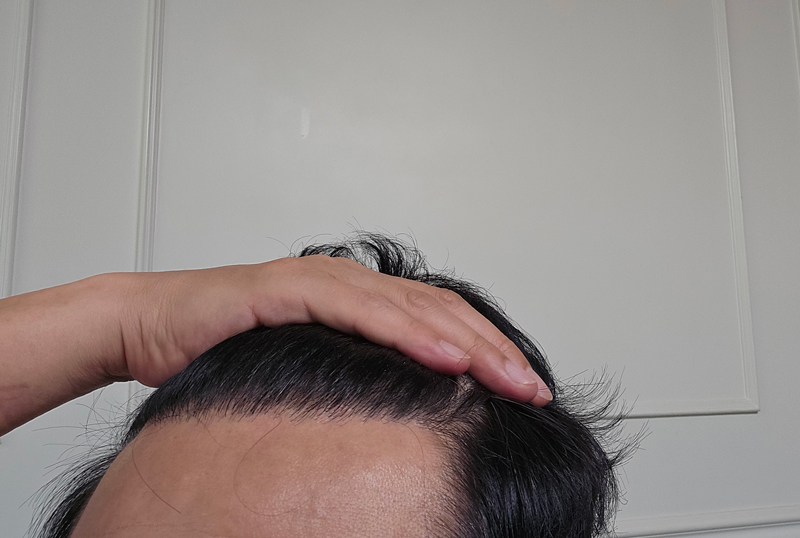 다나성형외과 무삭발비절개 20개월입니다.