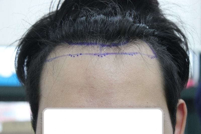 수술직전 디자인.JPG