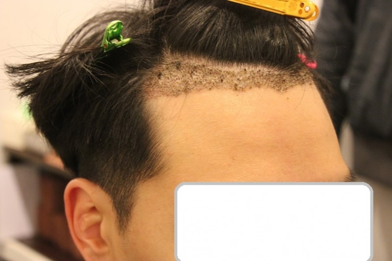 10일차 딱지제거 전.JPG