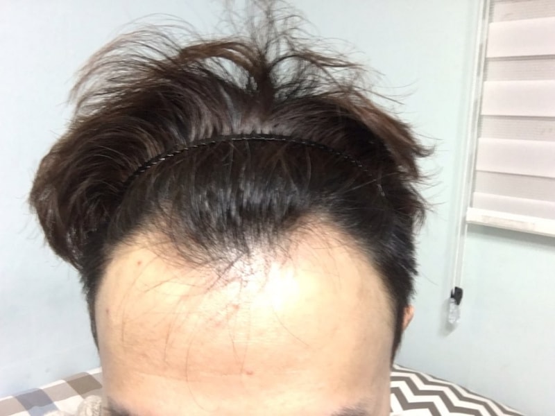 디자인 대 만족입니다 절개수술 했어요