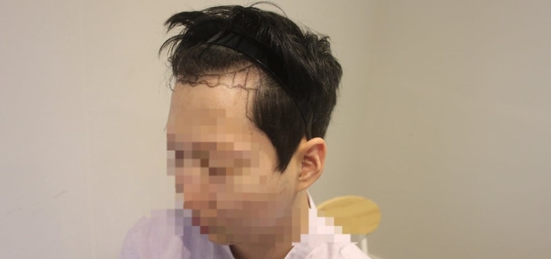 뉴헤어 서울점 비절개 모발이식 1200모낭 12개월차 후기 남겨드립니다~~!!