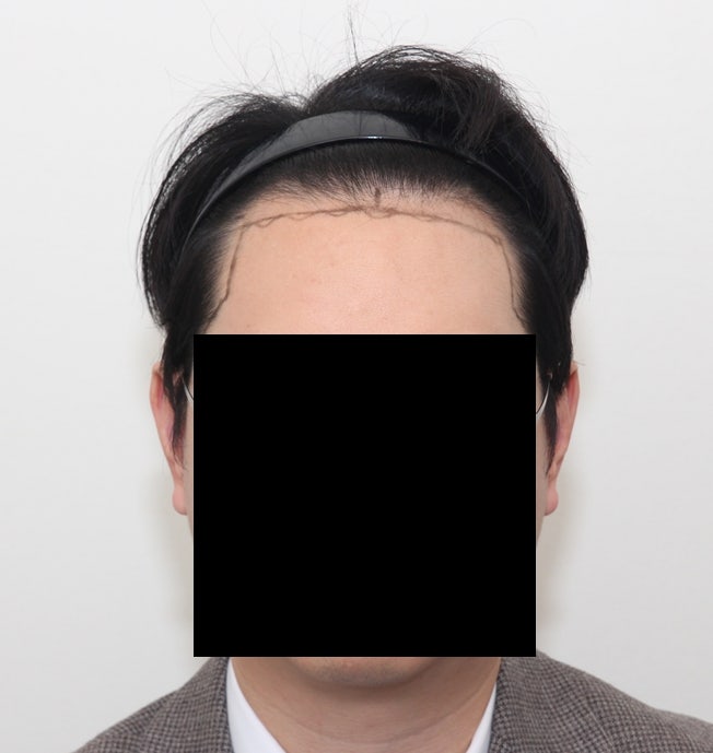 뉴헤어모발성형외과 1400모낭 7개월차 절개 후기